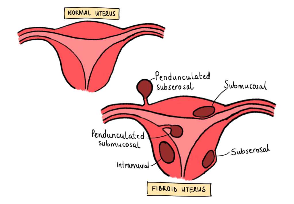 fibroid uterus